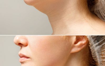 Cómo eliminar la papada: tratamientos sin cirugía y alternativas efectivas en Gran Canaria